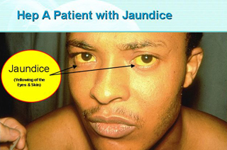 Jaundice Symptoms of the Eyes