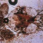 Scabies Under Microscope Scabies Under Microscope