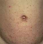 Scabies Rash on Stomach Scabies Rash on Stomach