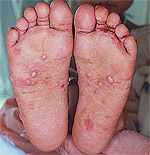 Scabies Rash on Feet
