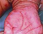 Scabies on Hand