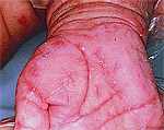 Scabies on Hand Scabies on Hand