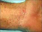 Scabies on Wrist Scabies on Wrist