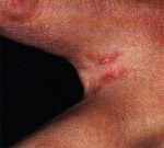 Scabies on Toes Scabies on Toes