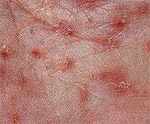 Scabies up Close Scabies up Close